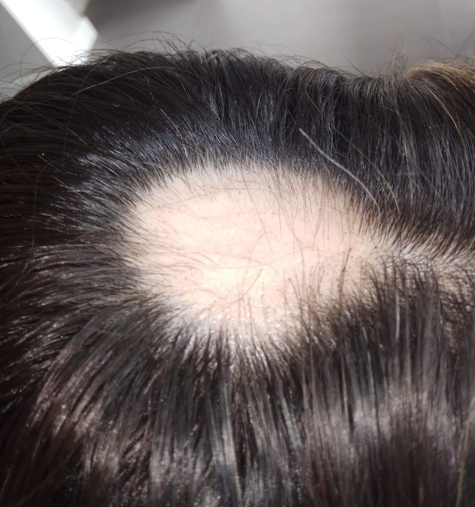tratamientos alopecia susana dopazo hair beauty tratamientos alopecia susana dopazo hair beauty